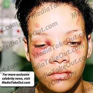 Pictures Of Rihanna After The Fight 68